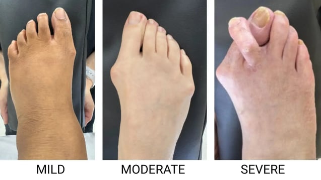 Bunion Progress-1