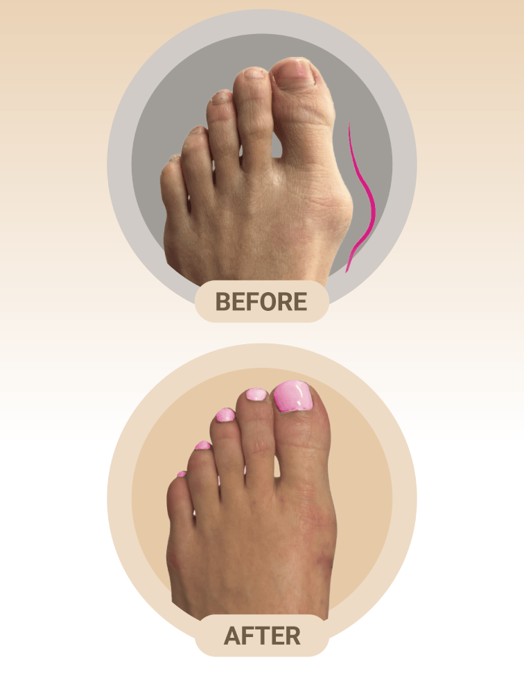 Bunion Before and After