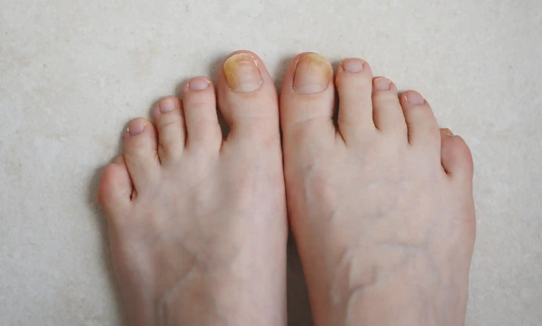 FACA - Fungal Toenails