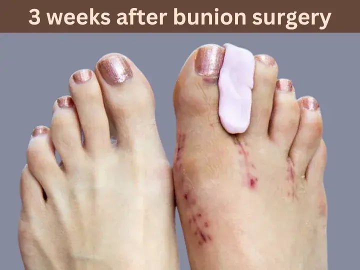 3 weeks after bunion surgery