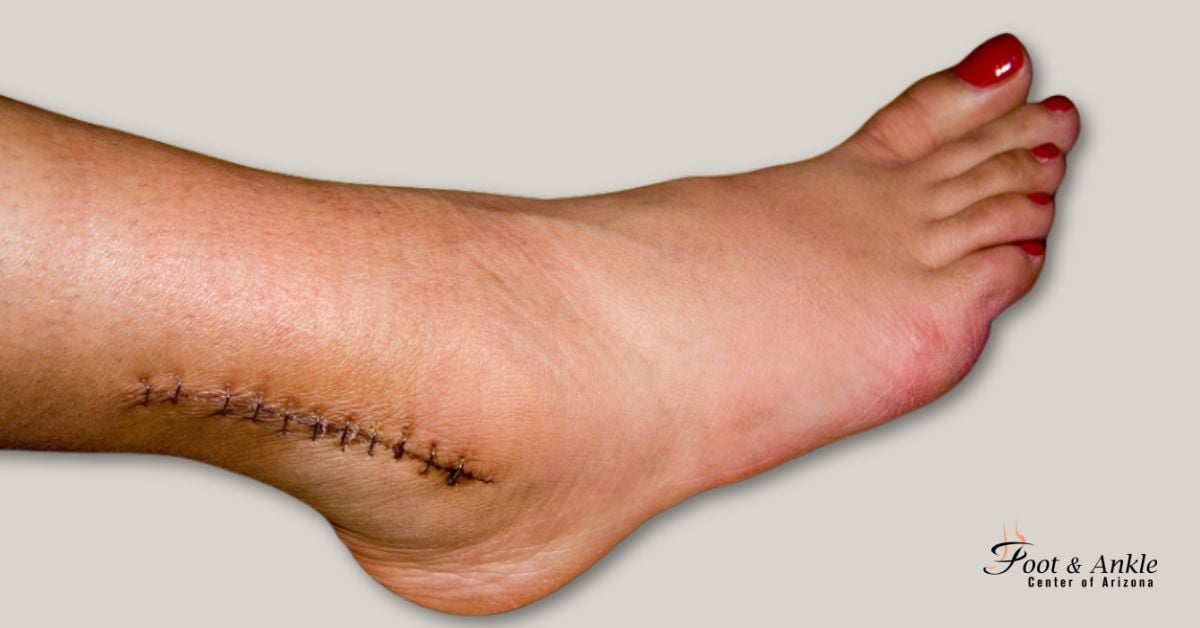 Ankle Surgery