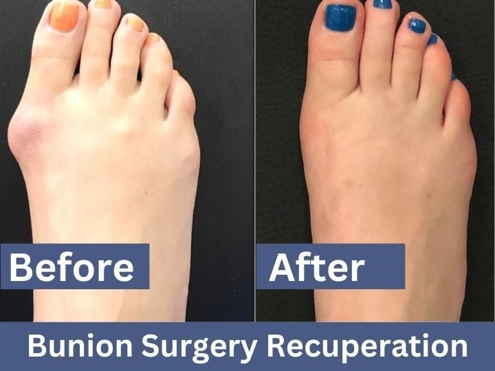 Bunion Surgery Recuperation Before and After