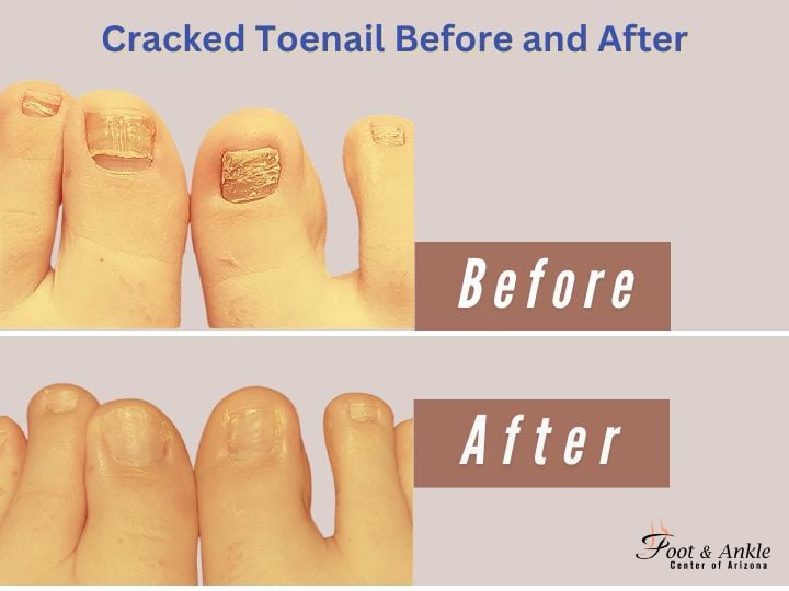 Cracked Toenail Before and After
