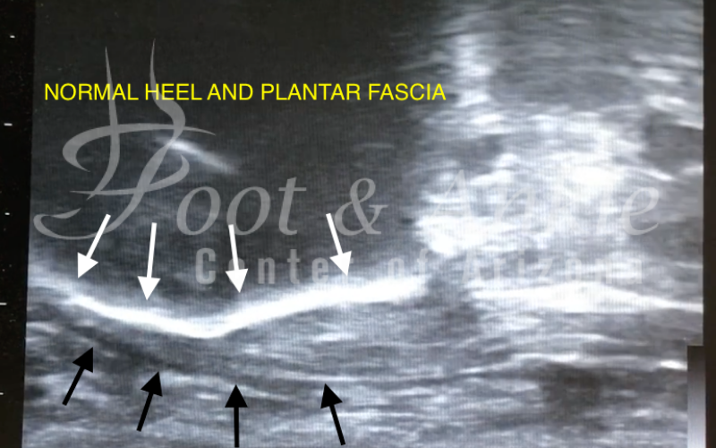 normal heel, Treatment for Your Heel Pain