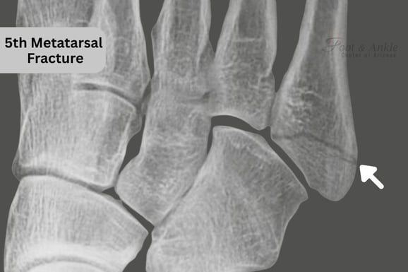 Hairline Fracture of 5th Metatarsal