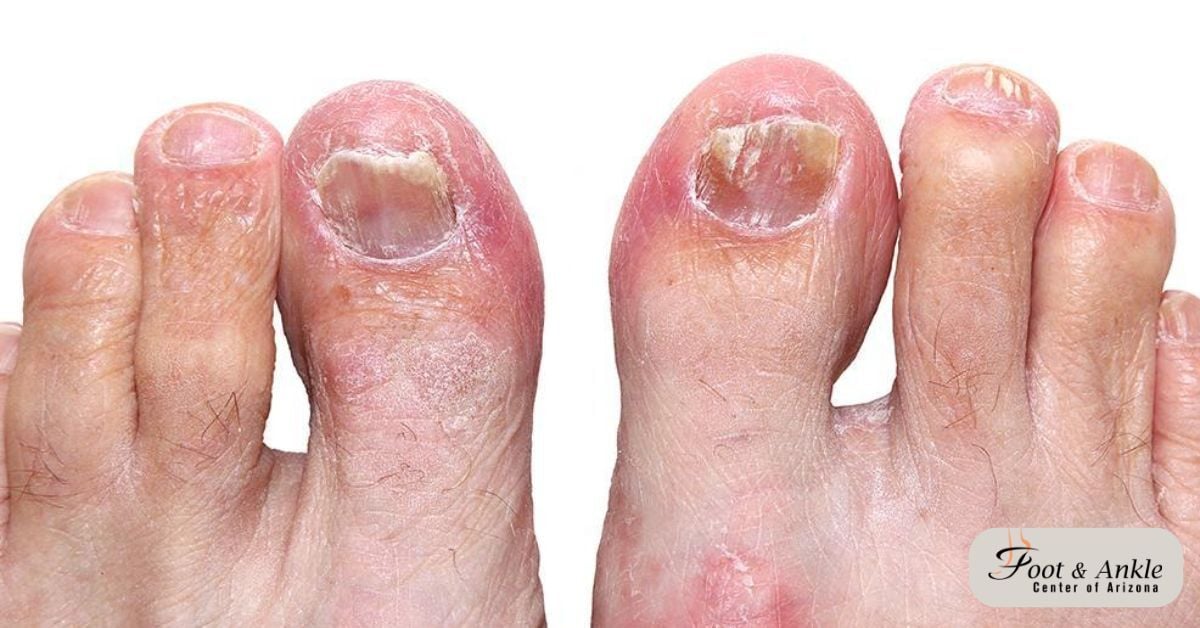 How to Get Rid of a Toe Infection – Expert Guide