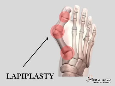 Lapiplasty