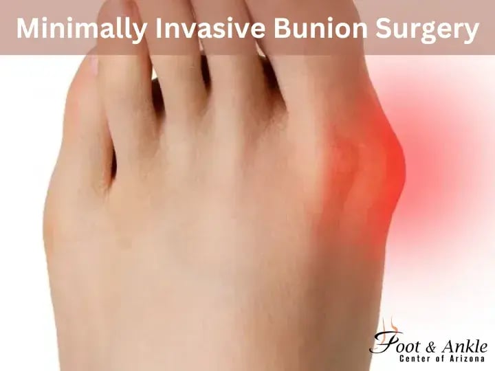 Minimally Invasive Bunion Surgery