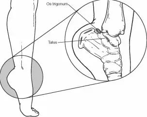 Os Trigonum Syndrome picture