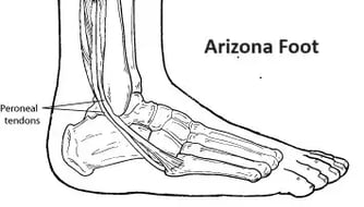 Peroneal Tendon Injuries bone picture