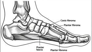 Plantar Fibroma treatment