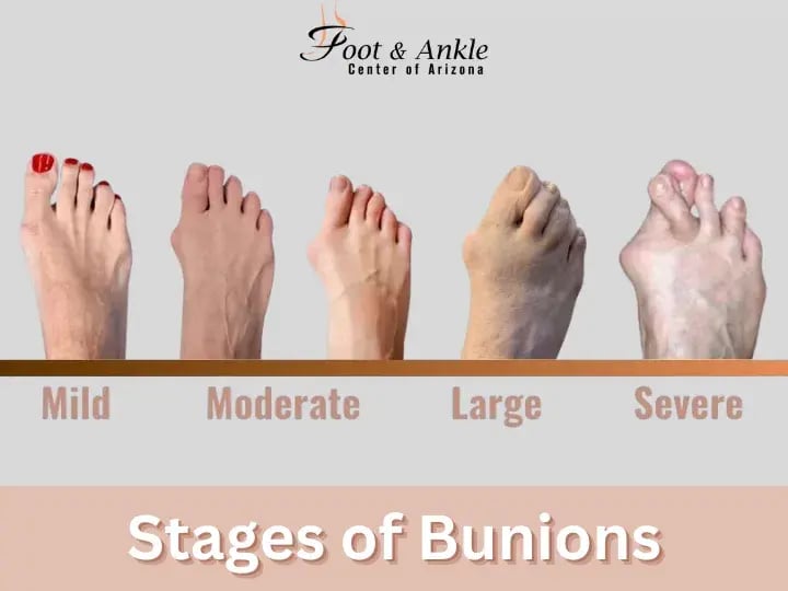 Stages of Bunions