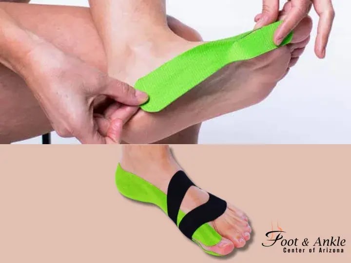 Taping for Bunions