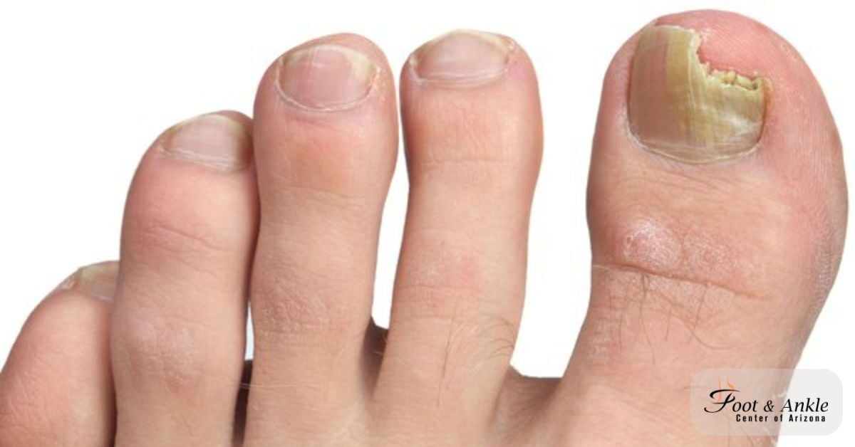 Toenail Fungus Treatment Progress