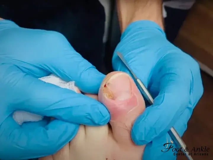 What Causes Ingrown Toenails