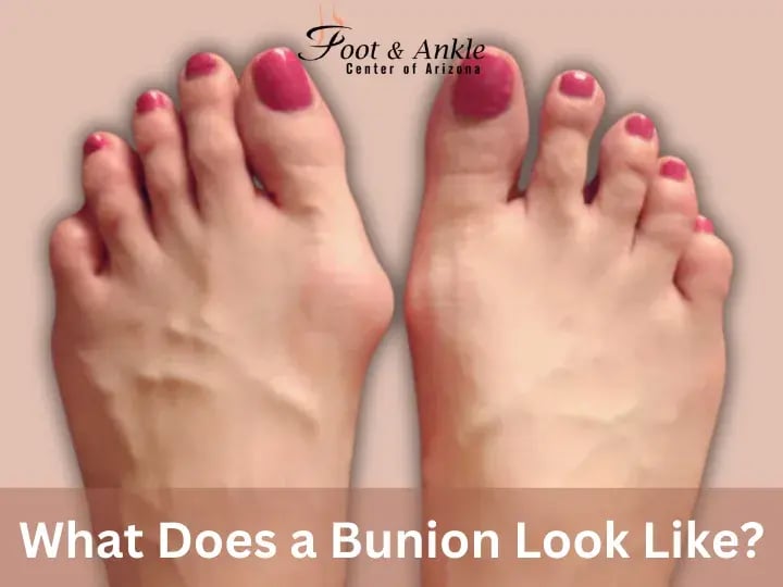 What Does a Bunion Look Like