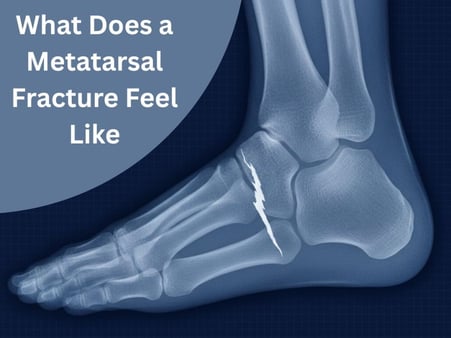 What Does a Metatarsal Fracture Feel Like