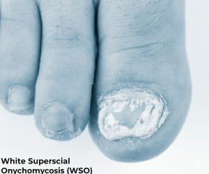 White Superficial Onychomycosis (WSO)