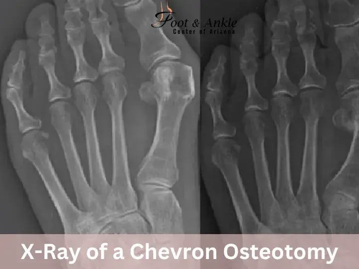 X-Ray of a Chevron Osteotomy