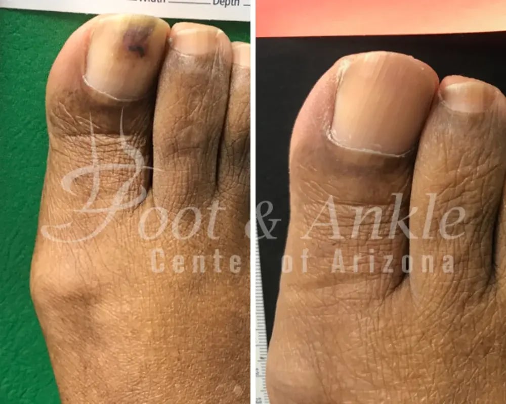toe fungus medication