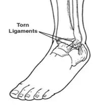 High Ankle Sprain picture