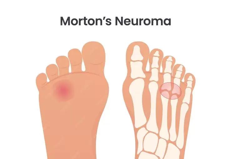 Morton s Neuroma Intermetatarsal Neuroma Foot Ankle Center Of Arizona