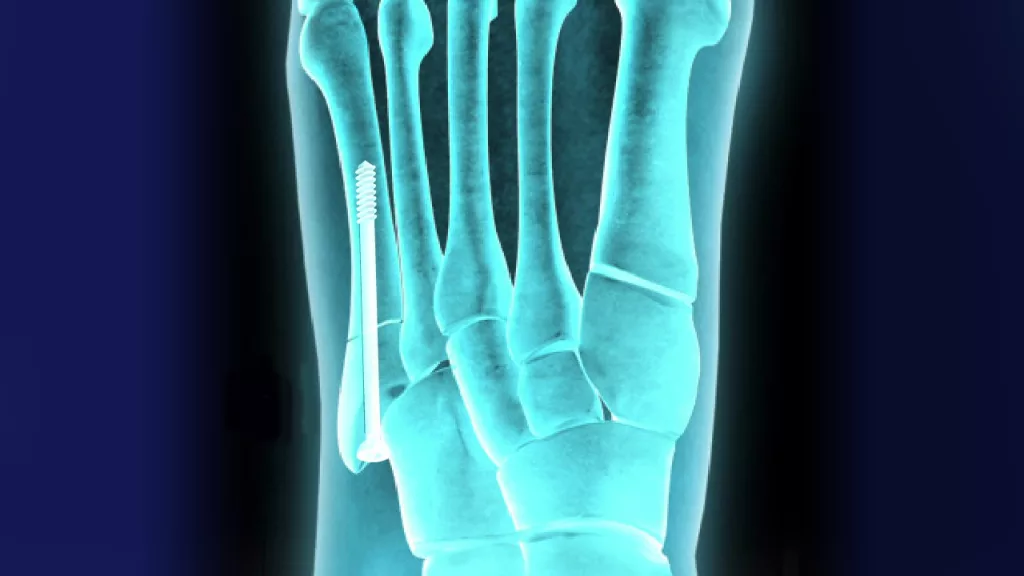 Jones Fracture Fixation