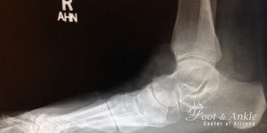 flatfoot deformity