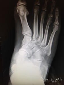 flatfoot deformity xray