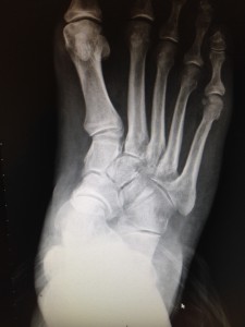 flatfoot deformity