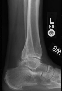 total ankle replacement