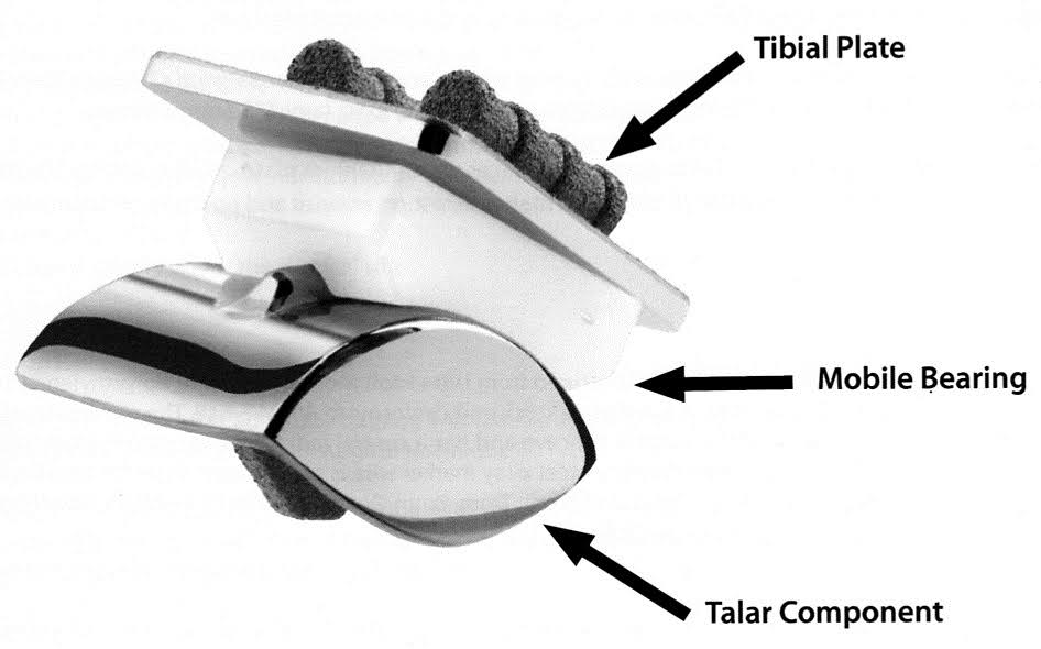 total ankle replacement