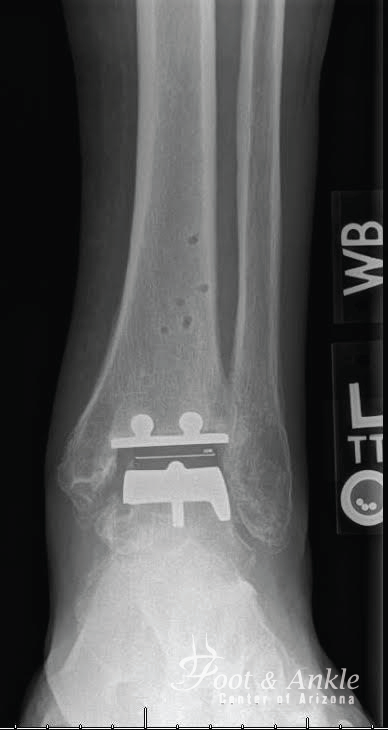 total ankle replacement