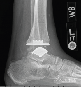 total ankle replacement