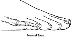 Hammertoe Normal Toes