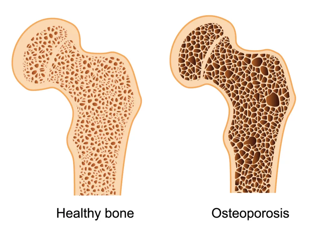 Osteoporosis icd 10