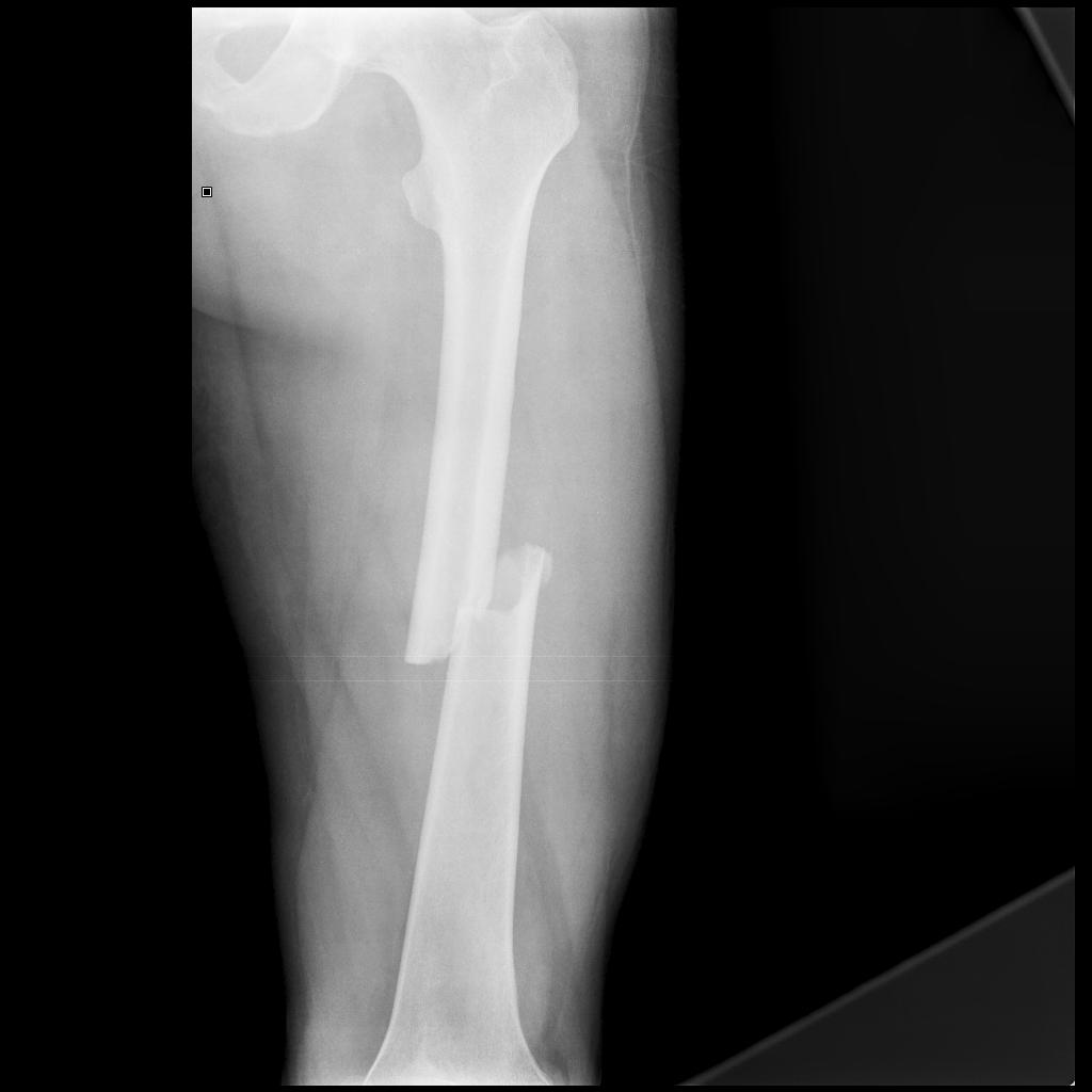 femur-fx-foot-ankle-center-of-arizona