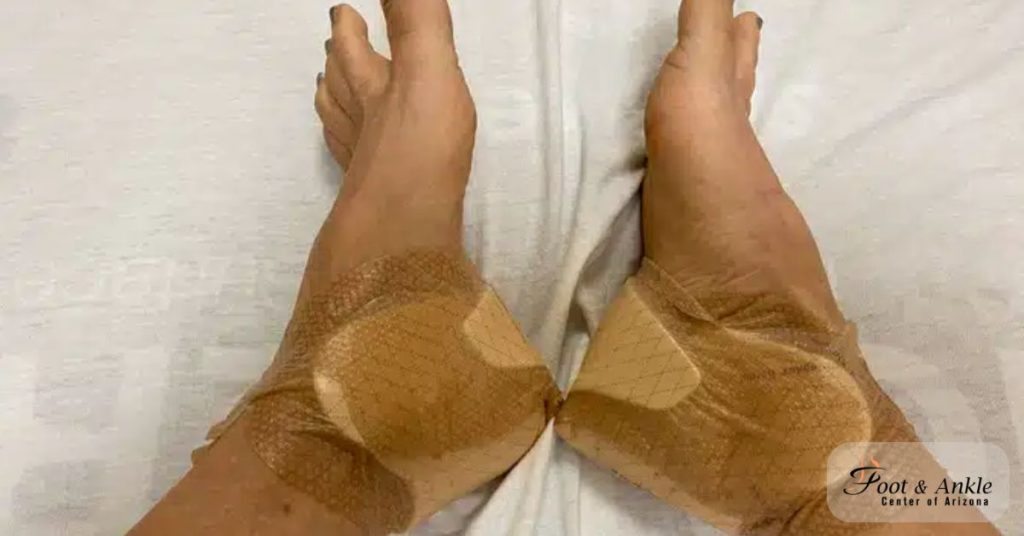 Recovering from Foot or Ankle Surgery