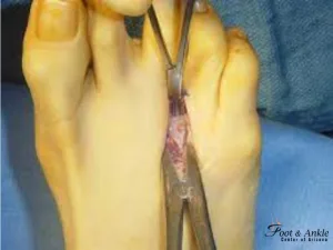 Neuroma Foot Surgery