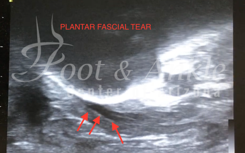 Plantar fascial tear