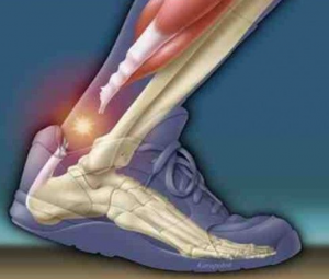 Common lower extremity injuries