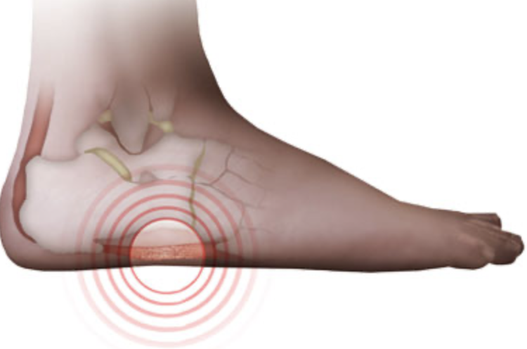 Lateral Foot Pain