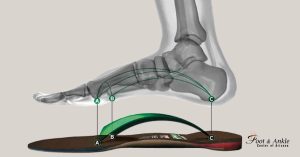 Custom shoe orthotics