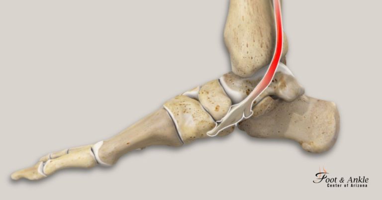 tibialis tendonitis