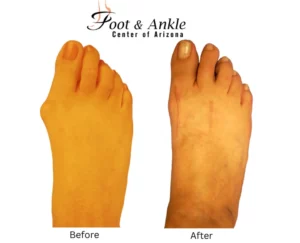 Before & After Foot 2
