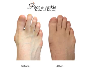 Before & After Foot 1