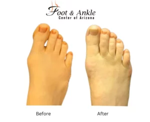 Before & After Foot 3