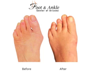 Before & After Foot 4