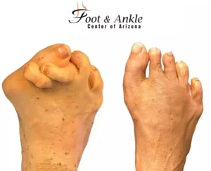 Before & After Foot 6