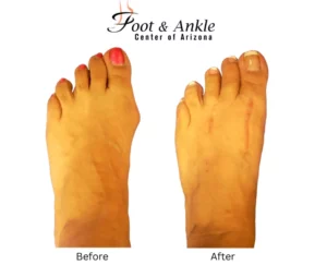 Before & After Foot 7